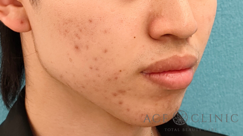 エラボトックス症例-芹澤医師