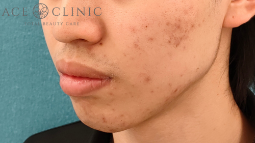 エラボトックス症例-芹澤医師