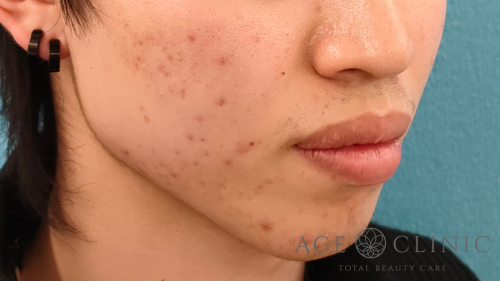 エラボトックス症例-芹澤医師