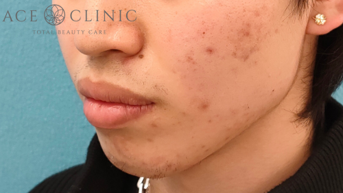 エラボトックス症例-芹澤医師