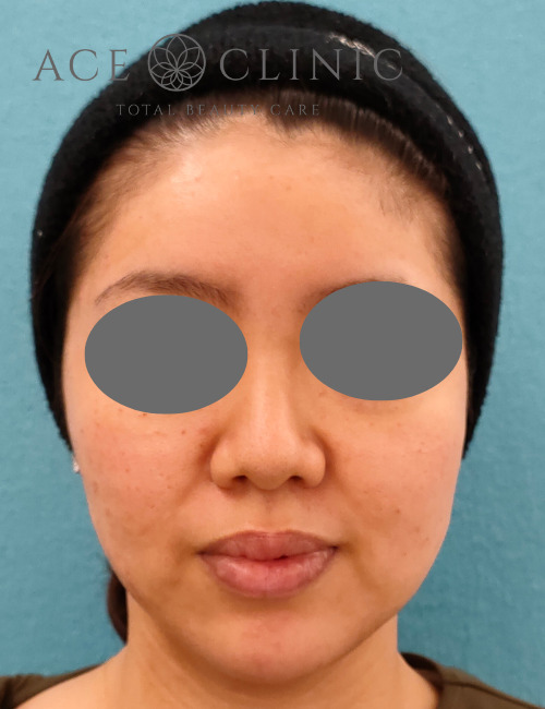 プルリアル術1日後