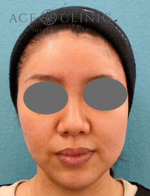 プルリアル術1週間後