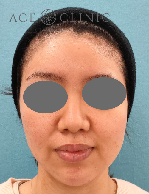 プルリアル術3日後