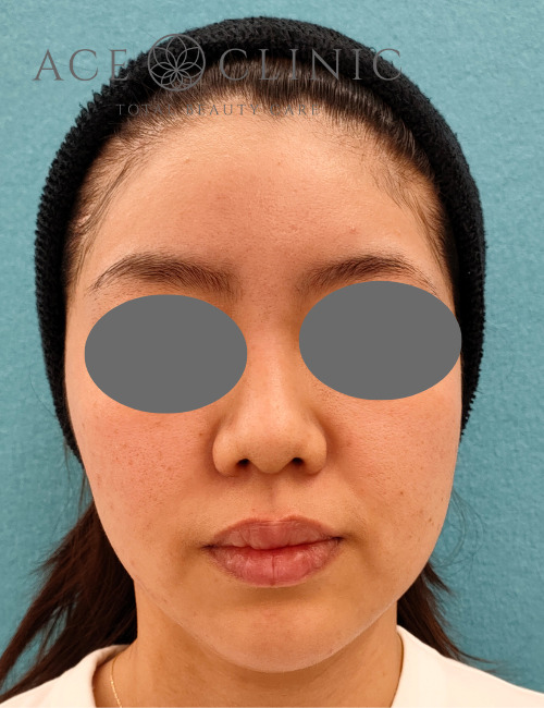 プルリアル術前