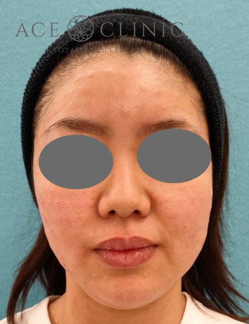 プルリアル術直後