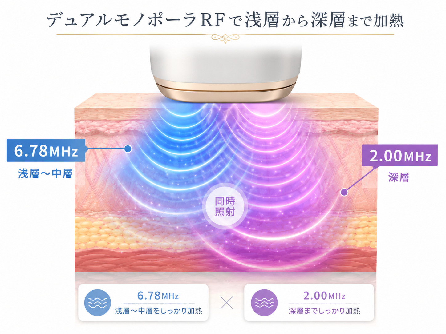 デュアルモノポーラRFで浅層から深層まで加熱