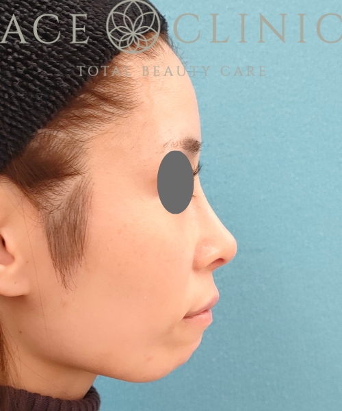 鼻中隔延長｜隆鼻術｜症例8｜20代女性｜術後6ヶ月｜エースクリニック名古屋院