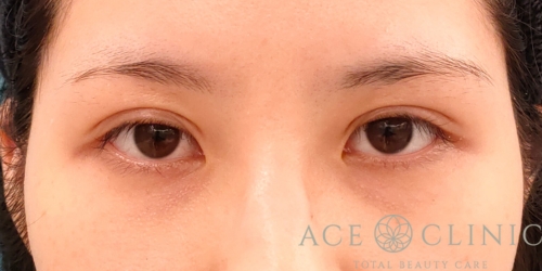 二重まぶた埋没法｜目頭切開｜症例55｜20代歳女性｜術後1ヶ月｜エースクリニック名古屋院