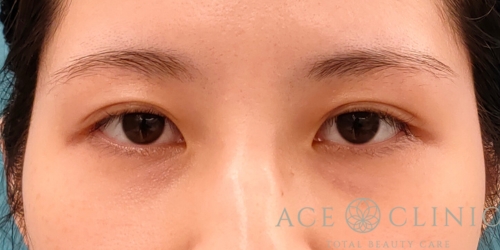 二重まぶた埋没法｜目頭切開｜症例55｜20代歳女性｜術前｜エースクリニック名古屋院