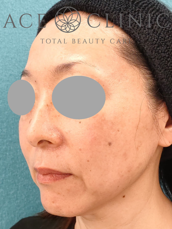 ショッピングリフト｜CASE3｜51歳女性｜施術後1ヶ月｜左斜め｜名古屋【エースクリニック】