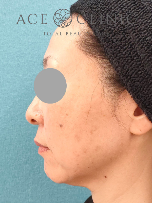 ショッピングリフト｜CASE3｜51歳女性｜施術後1ヶ月｜左横｜名古屋【エースクリニック】