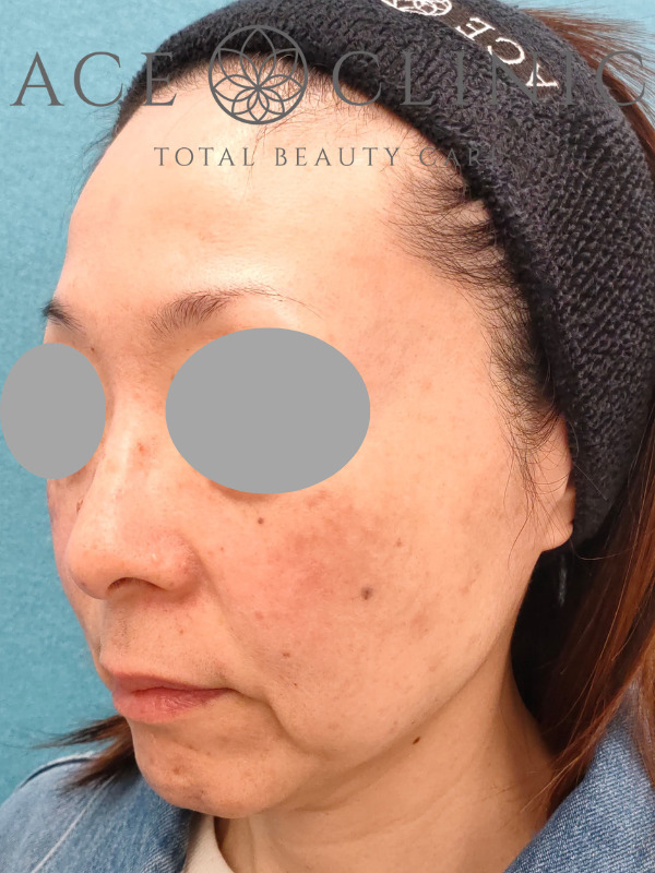 ショッピングリフト｜CASE3｜51歳女性｜施術前｜左斜め｜名古屋【エースクリニック】