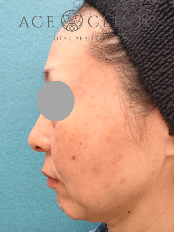 ショッピングリフト｜CASE3｜51歳女性｜施術前｜左横｜名古屋【エースクリニック】