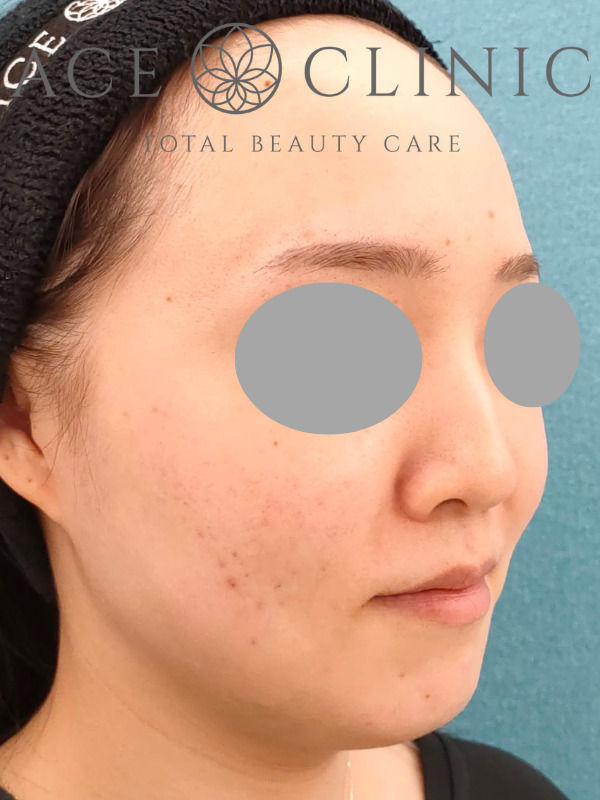 ショッピングリフト｜CASE3｜28歳女性｜施術後1ヶ月｜右斜め｜名古屋【エースクリニック】