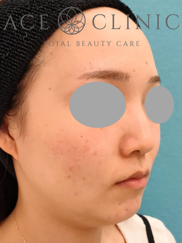 ショッピングリフト｜CASE3｜28歳女性｜施術前｜右斜め｜名古屋【エースクリニック】