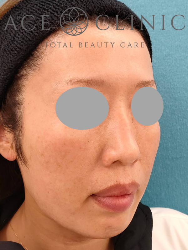 リポットレーザー｜顔｜症例10｜44歳女性｜施術後｜右斜め｜エースクリニック名古屋院