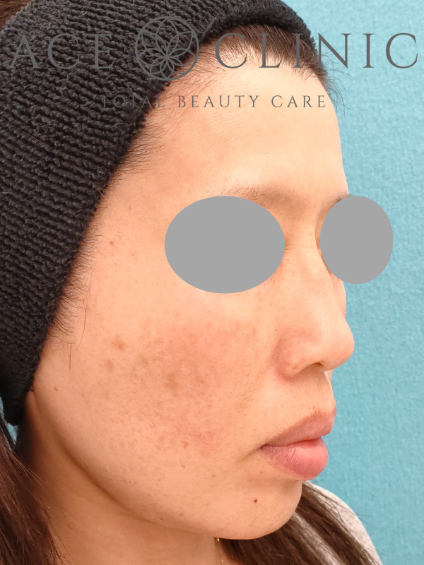 リポットレーザー｜顔｜症例10｜44歳女性｜施術前｜右斜め｜エースクリニック名古屋院