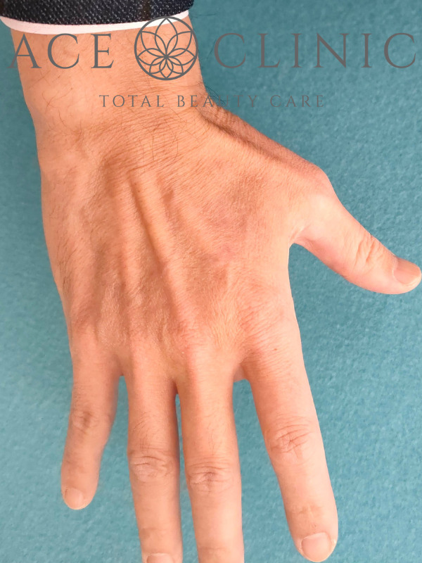 リポットレーザー｜手｜症例7｜53歳男性｜施術後｜エースクリニック名古屋院