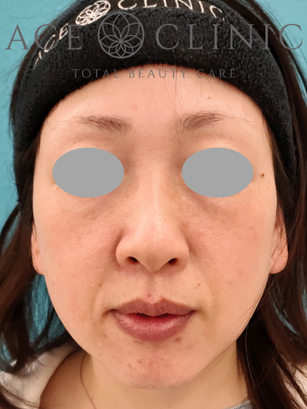 リポットレーザー｜顔｜症例8｜40歳女性｜施術後｜正面｜エースクリニック名古屋院