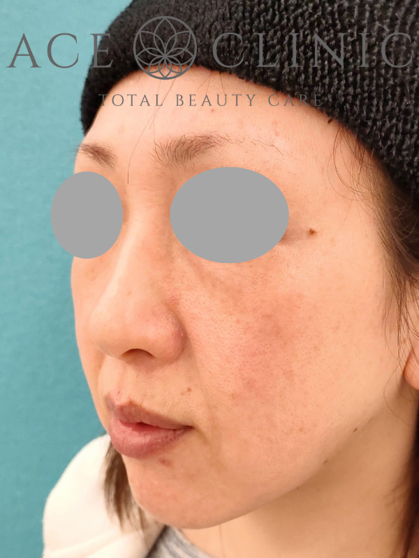 リポットレーザー｜顔｜症例8｜40歳女性｜施術後｜左斜め｜エースクリニック名古屋院