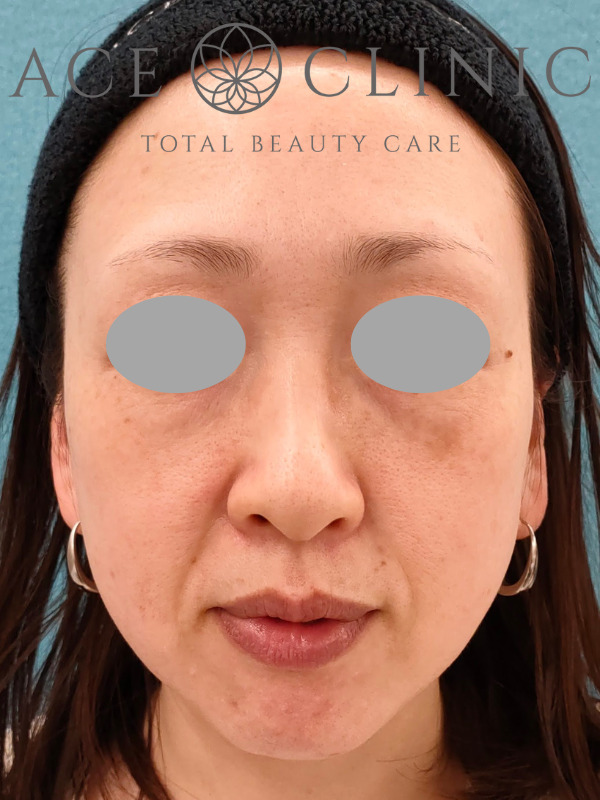 リポットレーザー｜顔｜症例8｜40歳女性｜施術前｜正面｜エースクリニック名古屋院