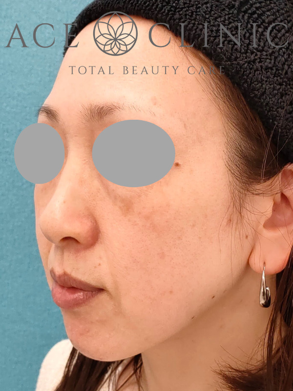 リポットレーザー｜顔｜症例8｜40歳女性｜施術前｜左斜め｜エースクリニック名古屋院