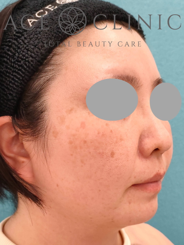 リポットレーザー｜顔｜症例9｜38歳女性｜施術前｜右斜め｜エースクリニック名古屋院