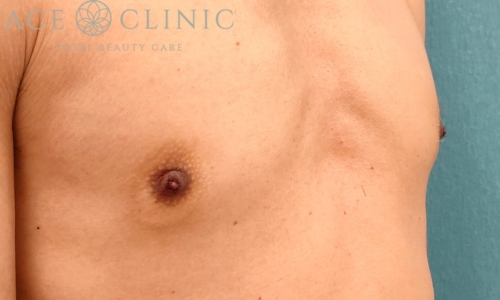 乳頭縮小｜症例45｜40代男性｜術前｜エースクリニック名古屋院