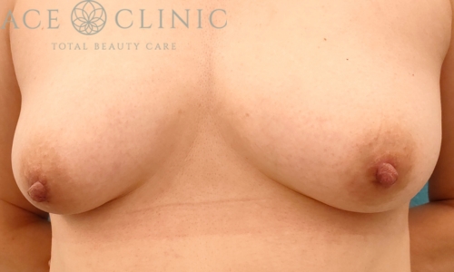 乳頭縮小｜症例47｜50代女性｜術後1ヶ月｜エースクリニック名古屋院