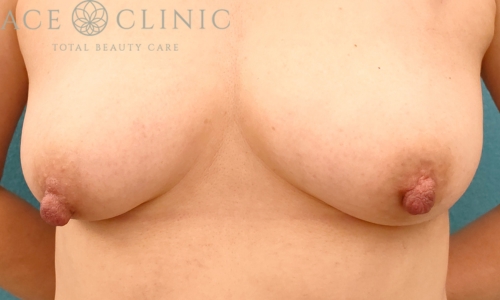 乳頭縮小｜症例47｜50代女性｜術前｜エースクリニック名古屋院