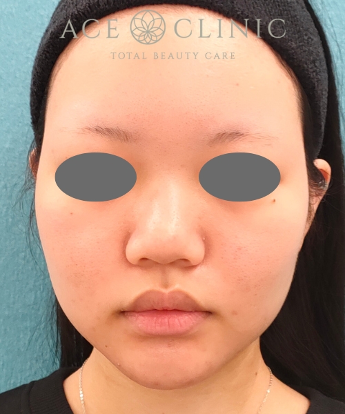 オンダリフト｜症例4｜女性｜術後｜エースクリニック名古屋