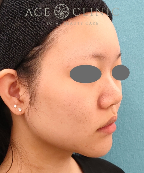 オンダリフト|症例4|女性|術後|エースクリニック名古屋