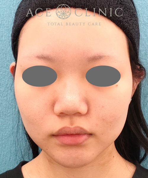 オンダリフト｜症例4｜女性｜術前｜エースクリニック名古屋