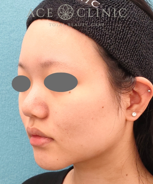 オンダリフト|症例4|女性|術前|エースクリニック名古屋