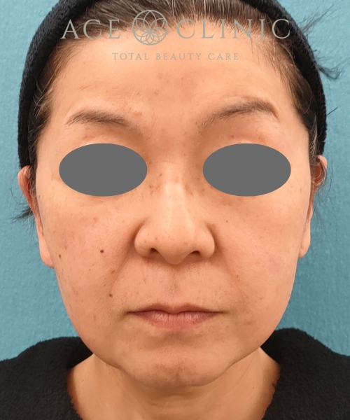 リポットレーザー｜症例12｜50代女性｜術後1ヶ月｜エースクリニック名古屋院