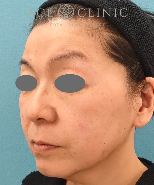 リポットレーザー｜症例12｜50代女性｜術後1ヶ月｜エースクリニック名古屋院