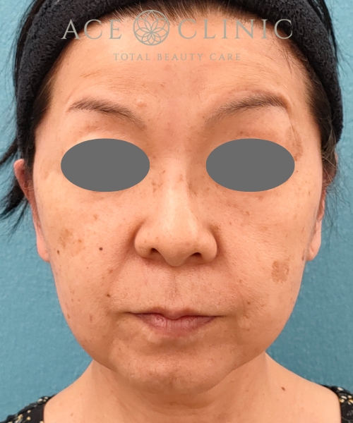 リポットレーザー｜症例12｜50代女性｜術前｜エースクリニック名古屋院