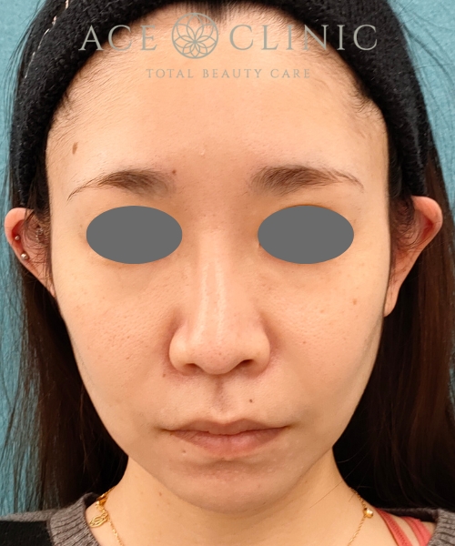 ザーフ｜症例4｜30代女性｜術後｜エースクリニック名古屋院