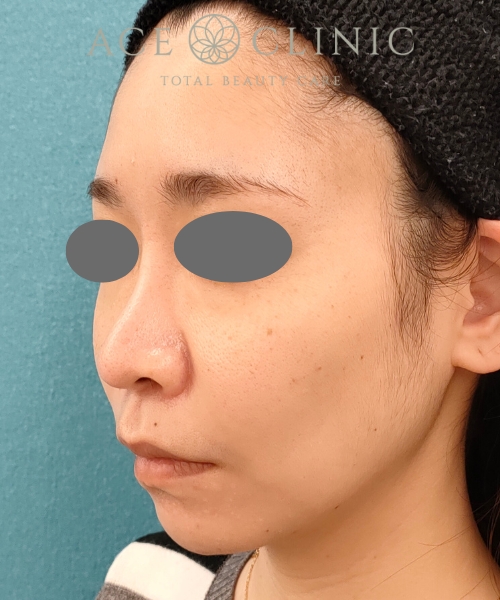 ザーフ|症例4|30代女性|術後|エースクリニック名古屋院