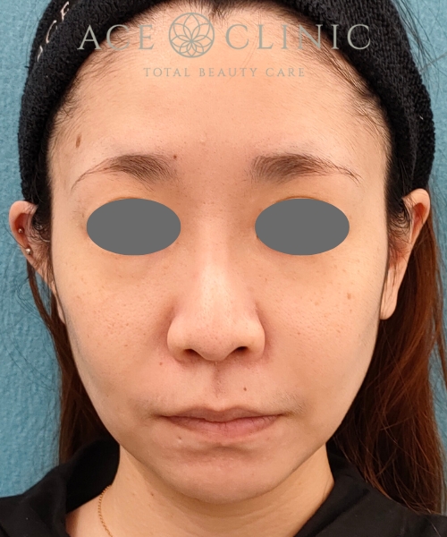 ザーフ｜症例4｜30代女性｜術前｜エースクリニック名古屋院