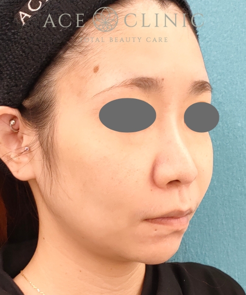 ザーフ|症例4|30代女性|術前|エースクリニック名古屋院