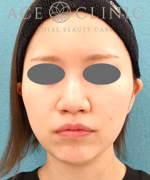 オンダリフト｜症例5｜20代女性｜術後3ヶ月｜エースクリニック名古屋