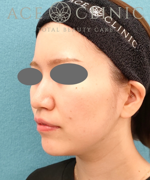 オンダリフト|症例5|20代女性|術後3ヶ月|エースクリニック名古屋