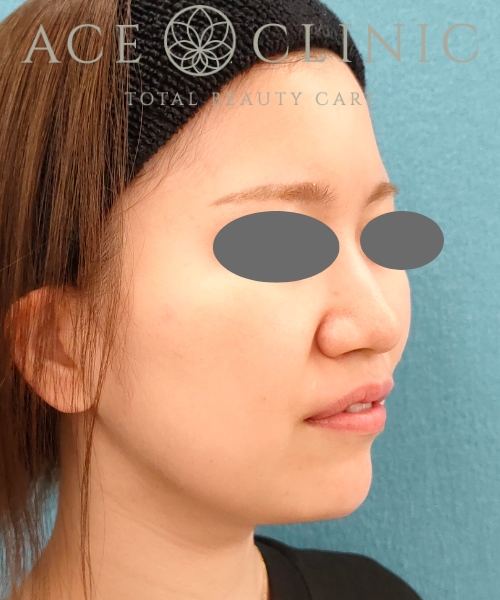 オンダリフト|症例5|20代女性|術後3ヶ月|エースクリニック名古屋