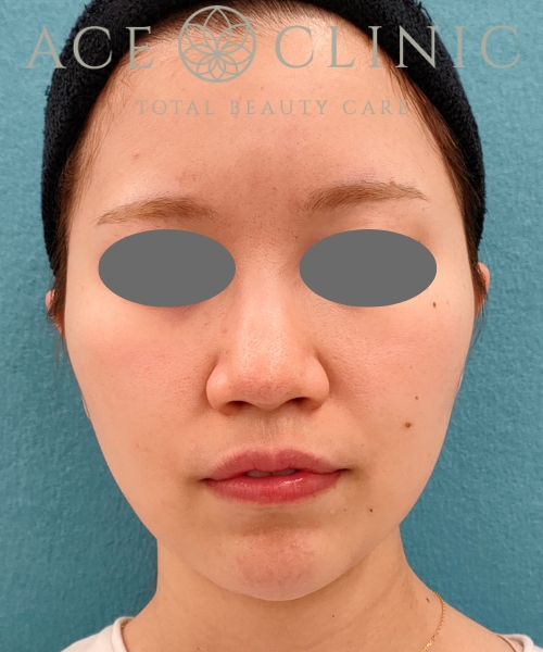 オンダリフト｜症例5｜女性｜術前｜エースクリニック名古屋