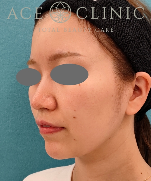 オンダリフト|症例5|20代女性|術前|エースクリニック名古屋