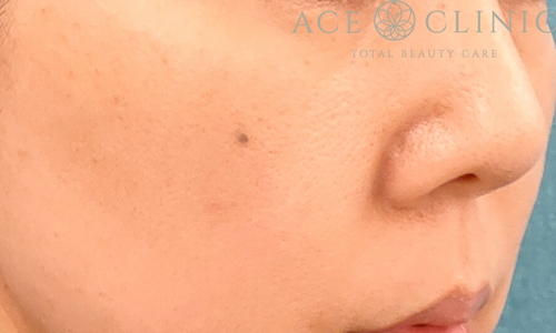 ブレッシング｜症例1｜女性｜3回目術後1ヶ月後｜エースクリニック名古屋院