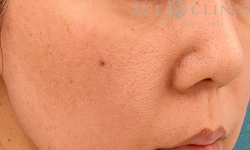 ブレッシング｜症例1｜女性｜術前｜エースクリニック名古屋院