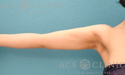 脂肪吸引｜上腕＋二の腕｜症例17｜35歳女性｜術後3ヶ月｜エースクリニック名古屋院