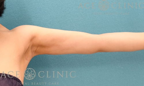 脂肪吸引｜上腕＋二の腕｜症例17｜35歳女性｜術後3ヶ月｜エースクリニック名古屋院